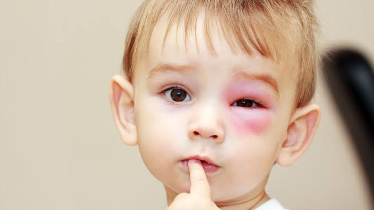 traumas oculares