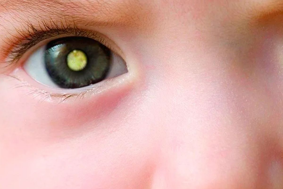 retinoblastoma