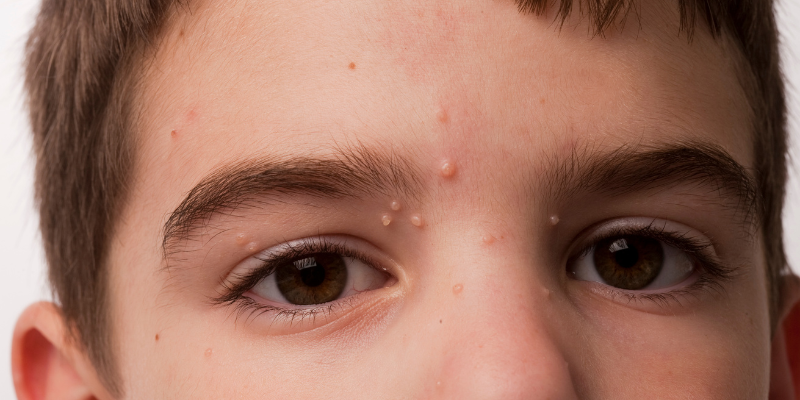molusco contagioso