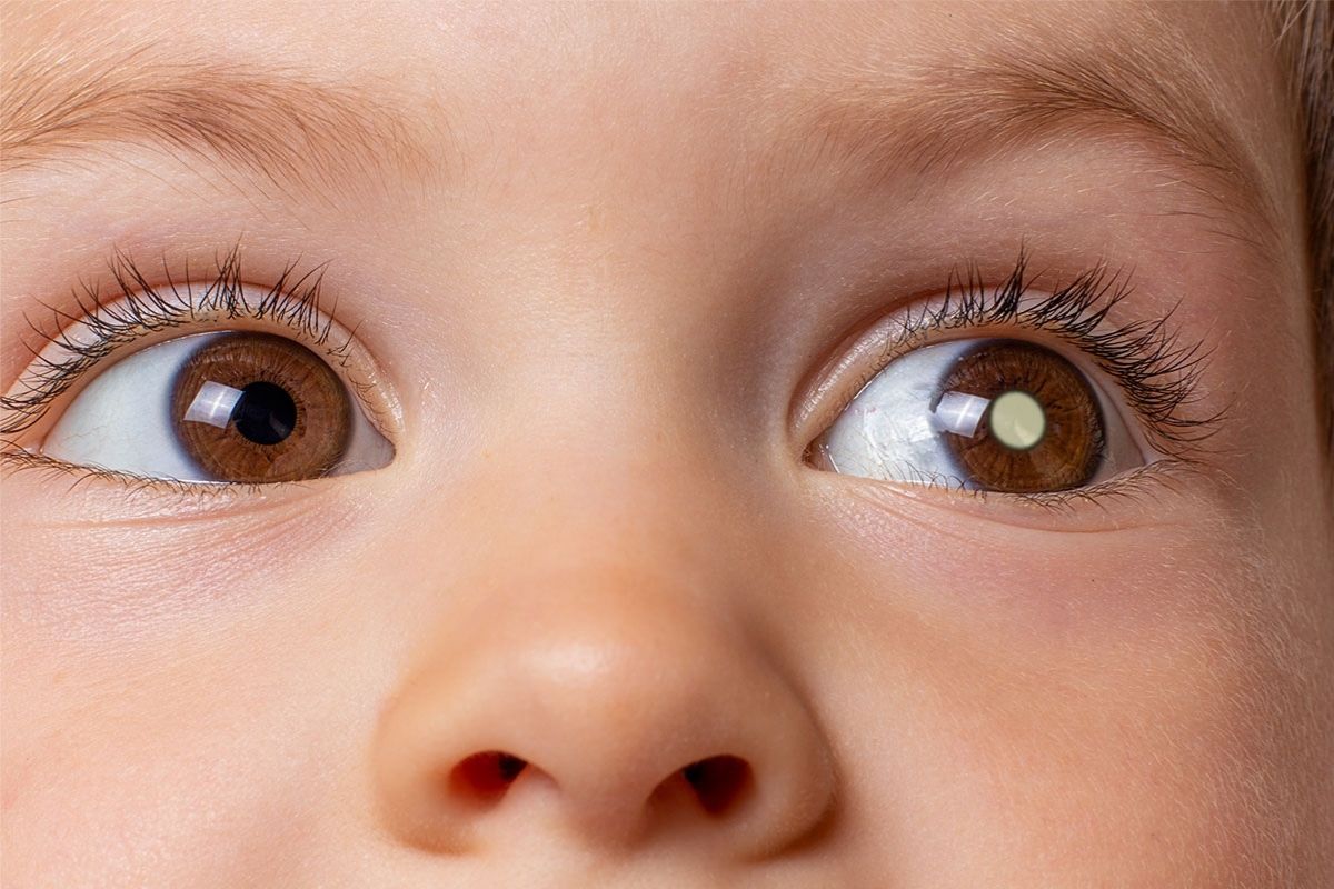 retinoblastoma câncer ocular