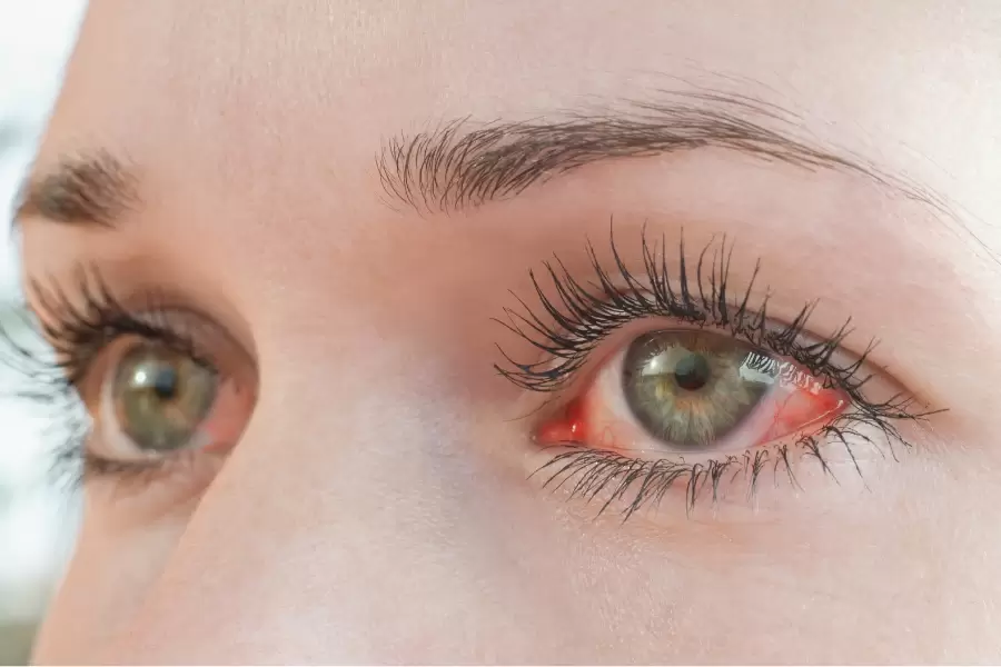 causas de vermelhidão nos olhos