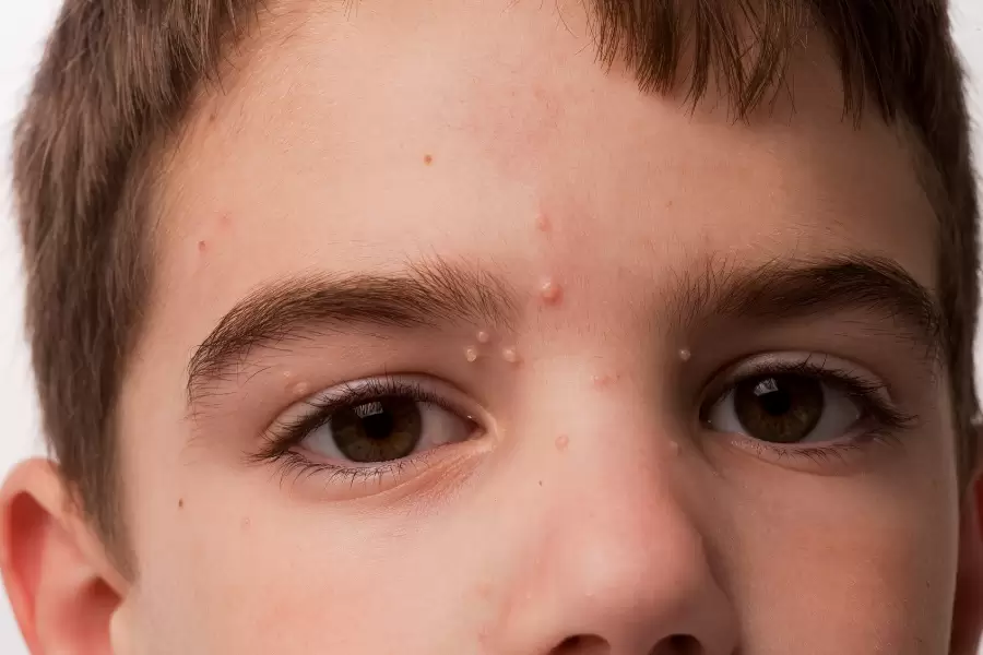 molusco contagioso ocular