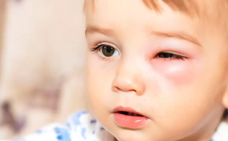sintomas da celulite ocular
